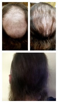 Hair Micropigmentation